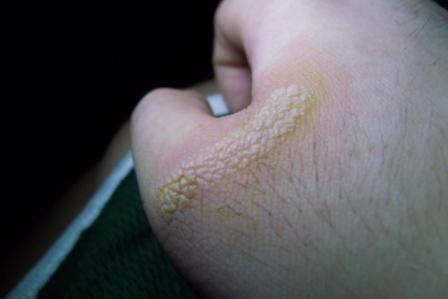 Burnt Skin